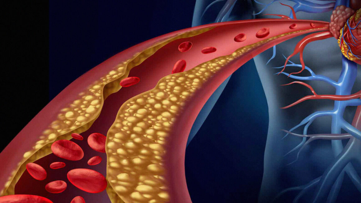 Dieta en Dislipidemia